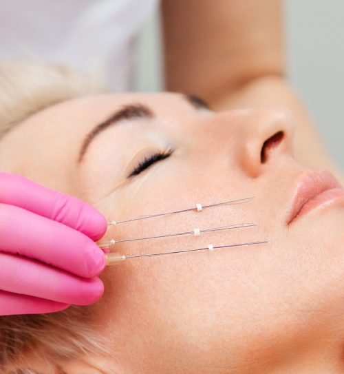 Thread,Lifting,Procediure.,Professional,Cosmetologist,In,Pink,Medical,Gloves,Holding